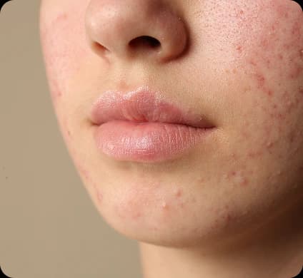 Aerolase Acne Scar Revision