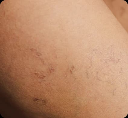 Facial & Leg Vein Removal