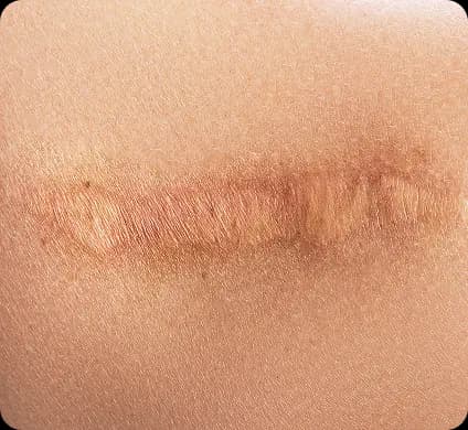 Surgical Scar Revision