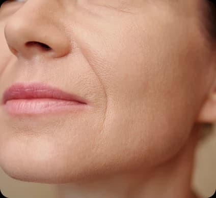 NeoSkin Rejuvenation
