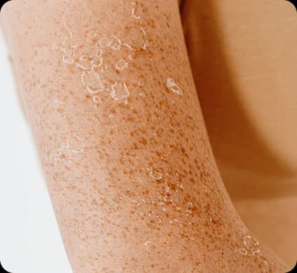 Rosacea & Redness Treatment