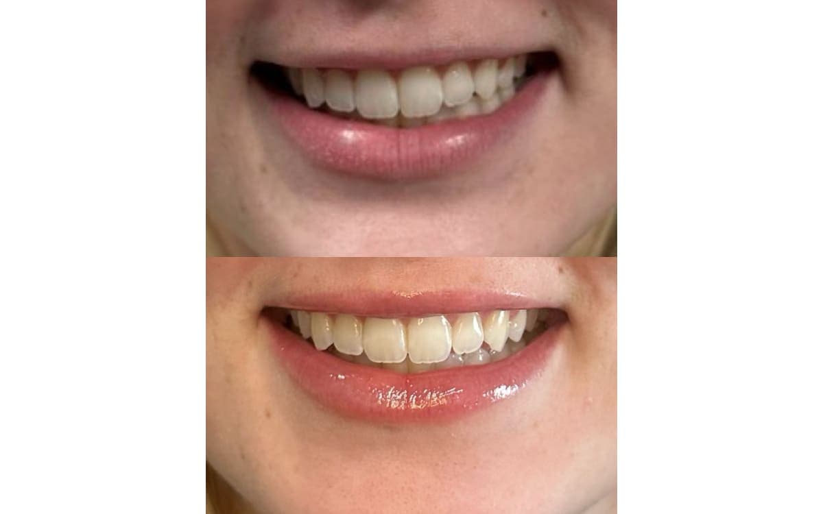 Before and after treatment result at Ren Aesthetics & Wellness